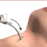 Trakeal şişkinliklərin mənası, səbəbləri, simptomları və müalicə üsulları: Traxeyada anormal böyümələrə baxış