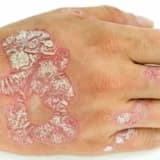Psoriasis: Dərinin xroniki və iltihablı bir xəstəliyi