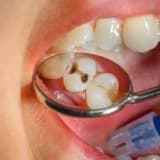Diş Çürükləri (Dental Karies): Səbəbləri, Simptomları və Müalicə Yolları