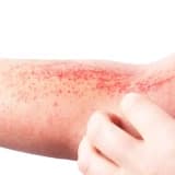 Dermatit: Dəri İltihabının Nəzərə Alınması