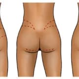 Popo kiçildilməsi (Gluteoplastika): Estetik və Tibbi Səbəblər