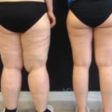 Lipödem (Lipedema) Tedavisi