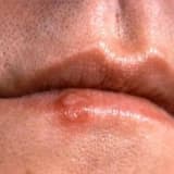 Dodaq xərçəngi (dodaq şişi)