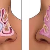 Septoplastika