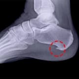 Daban tıxacları və müalicə üsulları