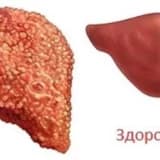 Qaraciyər xəstəlikləri (hepatit, siroz)
