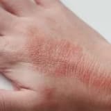 Pemfiqus xəstəliyi və ya Pemphigus Vulgaris