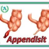 Appendisit