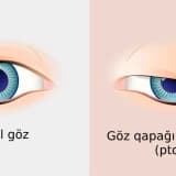 Ptoz