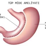Kol mədə əməliyyatı