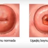 Uşaqlıq boynu eroziyası