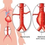 Aorta Anevrizması Cərrahiyyəsi: Həyat Xilasedici Prosedur