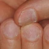 dırnaq xəstəlikləri