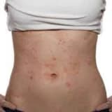 Allergik kontakt dermatit