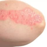 Psoriasis: simptomlar, səbəblər və müalicələr
