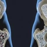 Osteoparoz