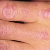 Dermatomiozit
