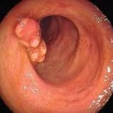 Çenber bagirsagin psevdopolipozu