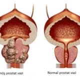 Prostat biopsiyası necə olmalıdır?