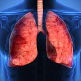 Ağciyər fibrozu