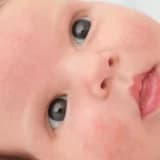 Uşaqlarda Qida Allergiyası