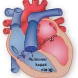 Pulmonal qapaq darlığı
