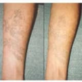 Tattoo Silmə - Tatuların Silinməsi