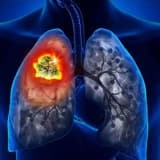 Ağciyər Xərçəngi: Səbəblər, Simptomlar və Müalicə Yolları