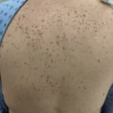 Mastositoz