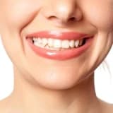 Masseter botoksu (bruksizm/diş sıxma botoksu) nədir?