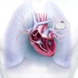 Defibrilasiya İmplantı: Ürək Ritmini Saxlamaq üçün Vacib Cihaz