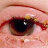 Adenovirus konyunktiviti