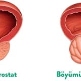 Prostat vezin adenomasi