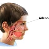 Adenoidektomiya