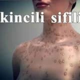 İkincili sifilis hakkında
