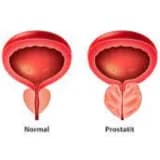 Prostat Vəzinin Böyüməsi: Səbəbləri, Simptomları və Müalicə Yolları