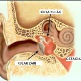 Orta qulaq infeksiyaları