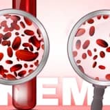 Anemiya, sümük iliyi çatışmazlığı