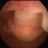 Endometriyanın polipi