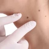 Anadangəlmə şiş, nevus (köstəbək), kütlələr, damar qüsurları, hemangiomalar