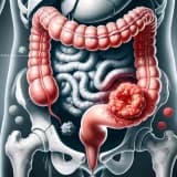 Kolon Xərçəngi: Səbəbləri, Simptomları və Müalicə Yöntəmləri