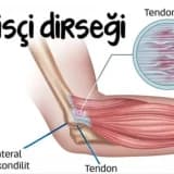 Tennis Dirsəyi Və Müalicəsi
