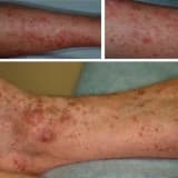 Dermatoz: Dəri Xəstəliklərinin Ümumi Baxışı