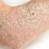 Sedef, liken və bənzər dermatit