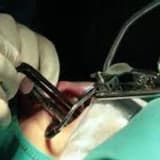 Qulağa tüp taxılması