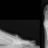 Hallux rigidus xəstəliyi