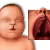 Yarıq dodaq damağı