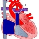 Aciq arterial axacaq