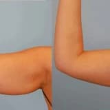 Qol Gərmə (Braxioplastika): Möhkəm və Estetik Qolların Açarı