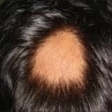 Saç Tökülməsi və Alopeçiya: Səbəbləri, Növləri və Müalicə Yolları